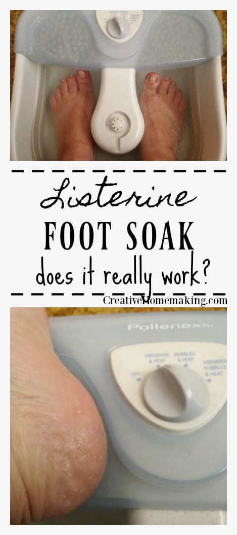 Does the Listerine foot soak really work to dissolve calluses on your feet? I tried this DIY home remedy to find out!