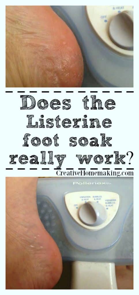 Does the Listerine and apple cider vinegar foot soak really work to dissolve calluses on your feet? I tried this DIY home remedy to find out!